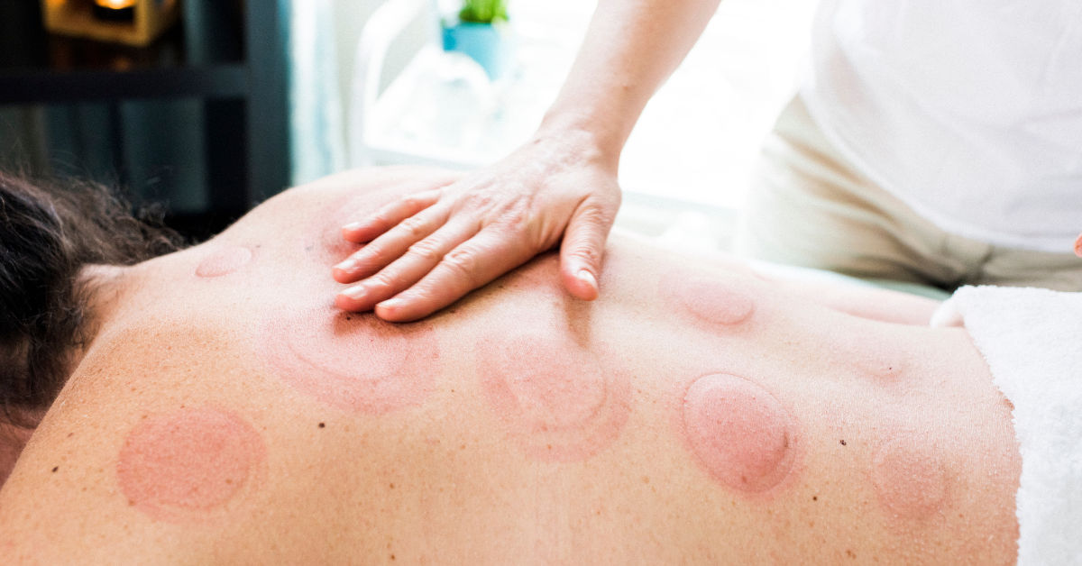 Cupping therapy results marks