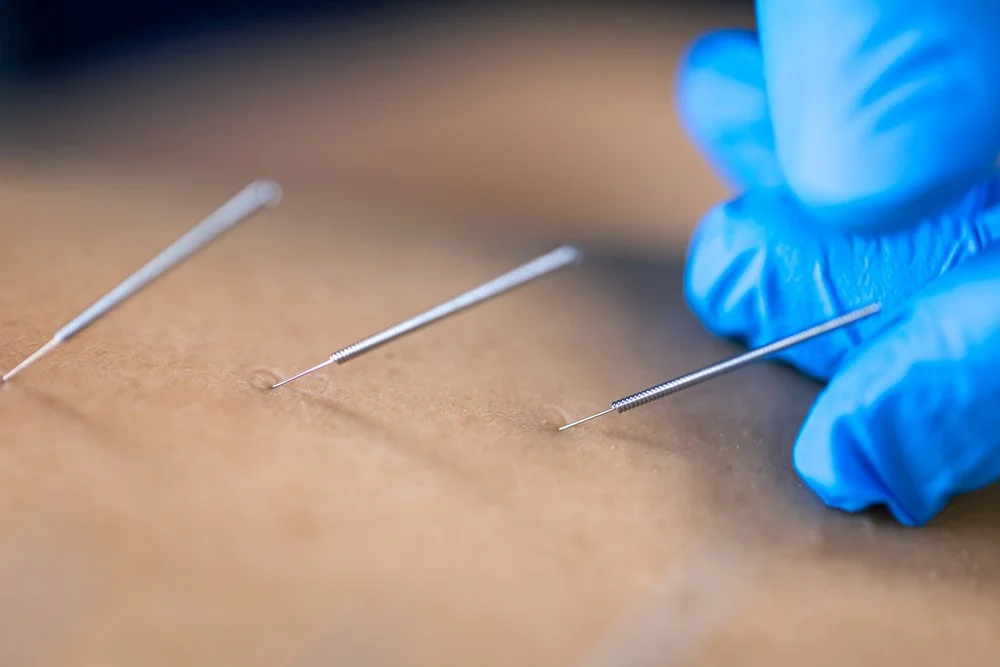 Dry Needling vs. Acupuncture: Understanding the Key Differences to Choose the Right Treatment for You — Acupuncture Xperts, Boca Raton FL