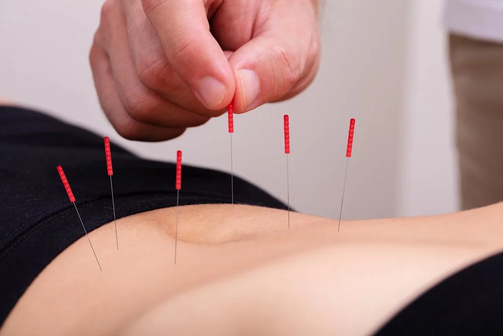 Stress Relief Acupuncture – How Acupuncture Eases Stress Naturally — Acupuncture Xperts, Boca Raton FL