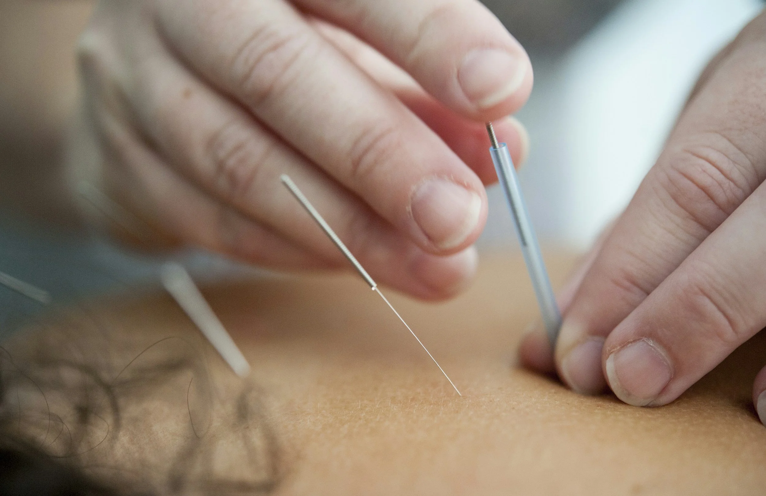 Why You Should Look into Acupuncture for Menopause and Weight Loss — Acupuncture Xperts, Boca Raton FL