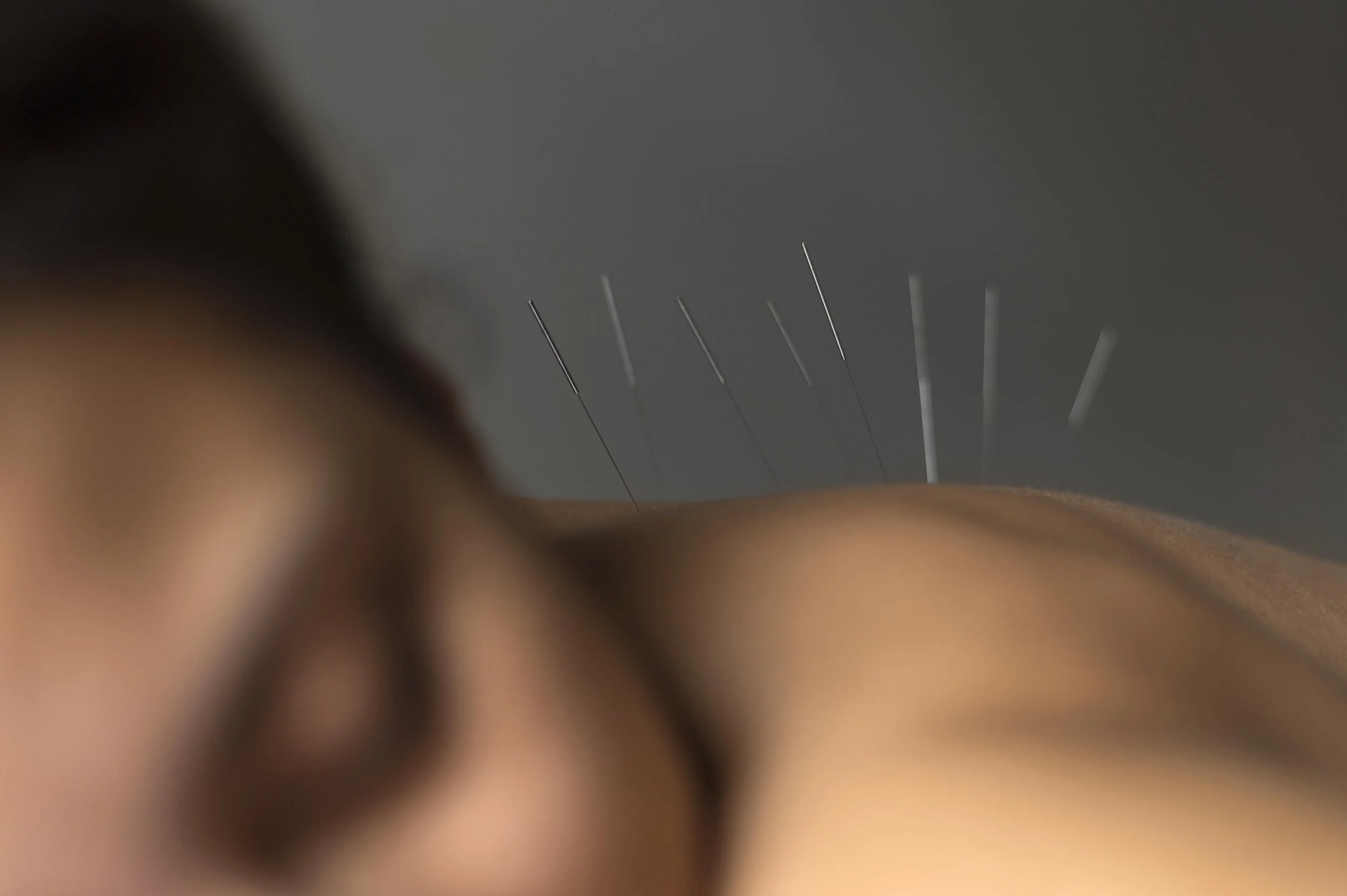 Close up patient acupuncture procedure